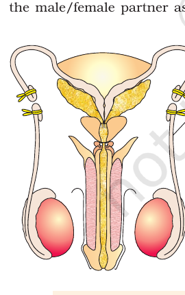 Figure 3.4(a) Vasectomy
