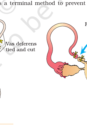 Figure 3.4(b) Tubectomy